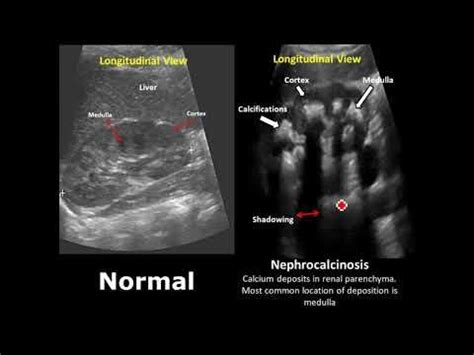 kub ultrasound normal results|Kidney, Ureter, Bladder (KUB) Point.